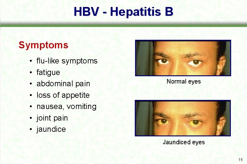 HBV - Hepatitis B Symptoms • • flu like symptoms fatigue abdominal pain loss