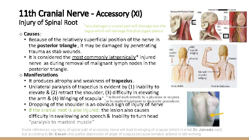 11 th Cranial Nerve - Accessory (XI) Injury of Spinal Root *any damage to