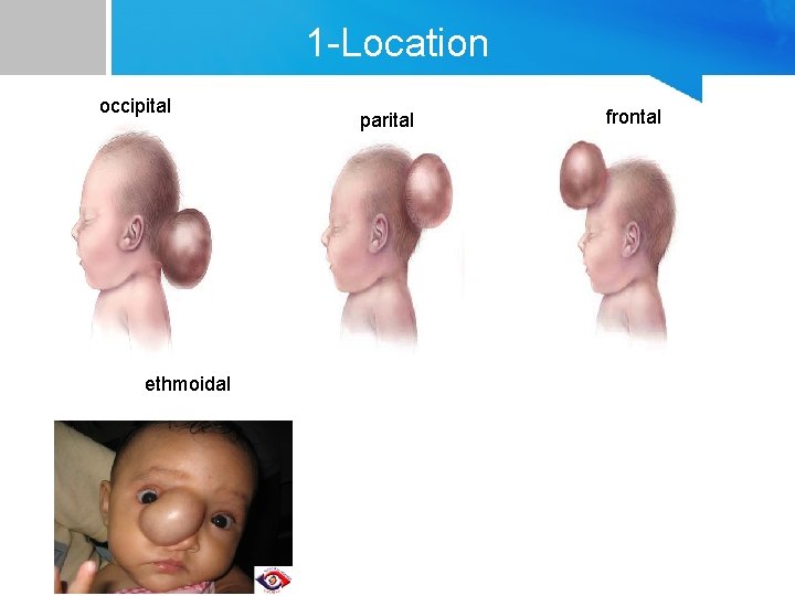 1 -Location occipital ethmoidal parital frontal 