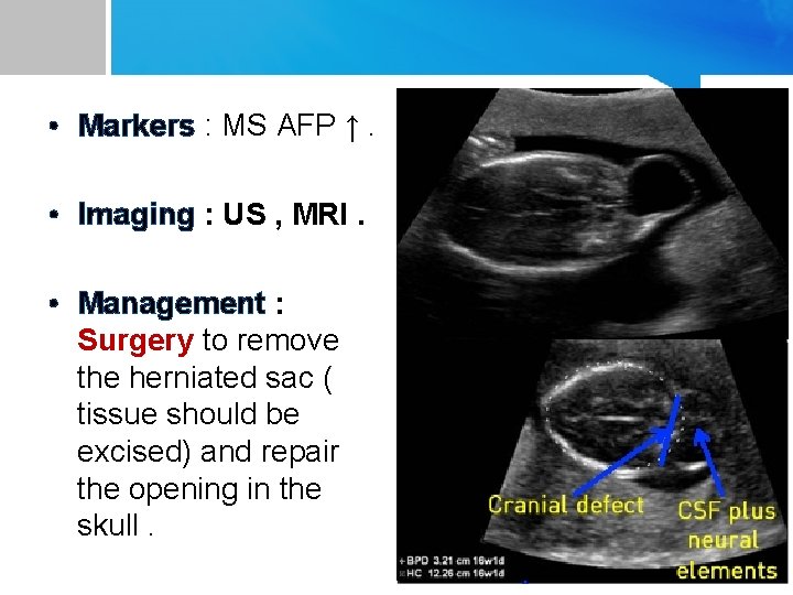  • Markers : MS AFP ↑. • Imaging : US , MRI. •