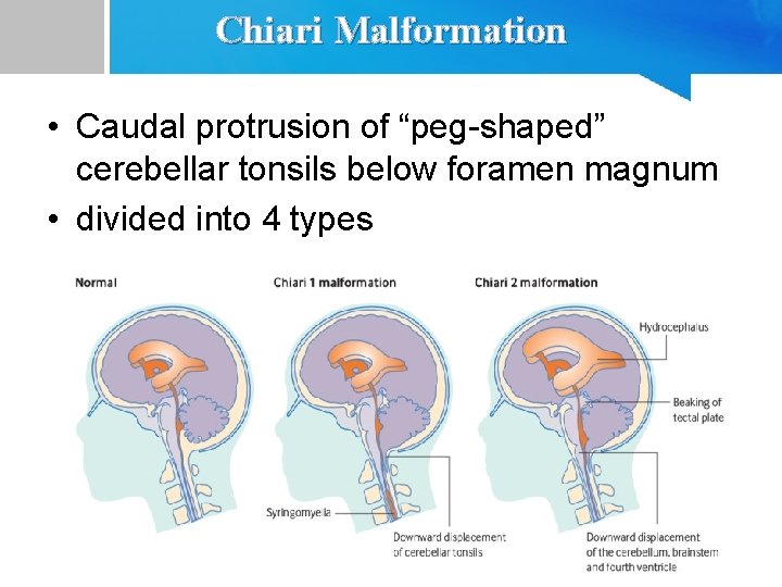 Chiari Malformation • Caudal protrusion of “peg-shaped” cerebellar tonsils below foramen magnum • divided