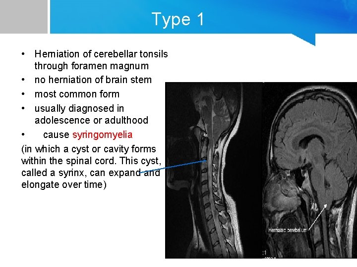 Type 1 • Herniation of cerebellar tonsils through foramen magnum • no herniation of
