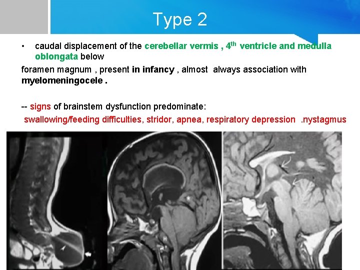 Type 2 • caudal displacement of the cerebellar vermis , 4 th ventricle and