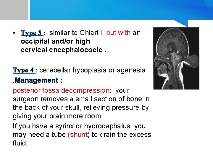  • Type 3 : similar to Chiari II but with an occipital and/or