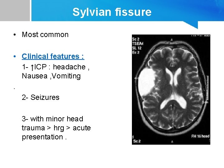 Sylvian fissure • Most common • Clinical features : 1 - ↑ICP : headache
