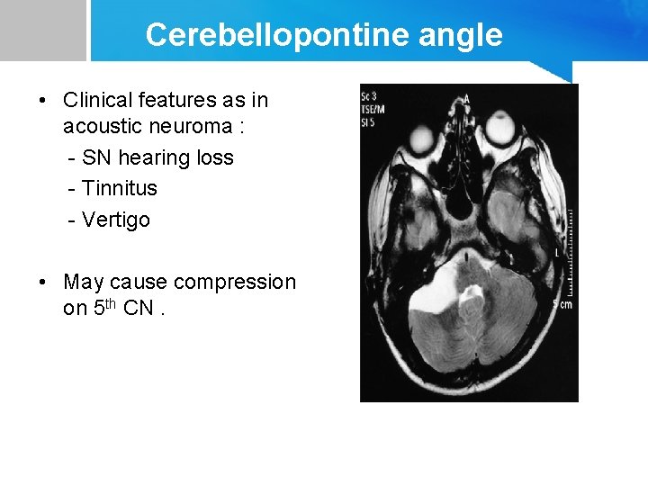 Cerebellopontine angle • Clinical features as in acoustic neuroma : - SN hearing loss