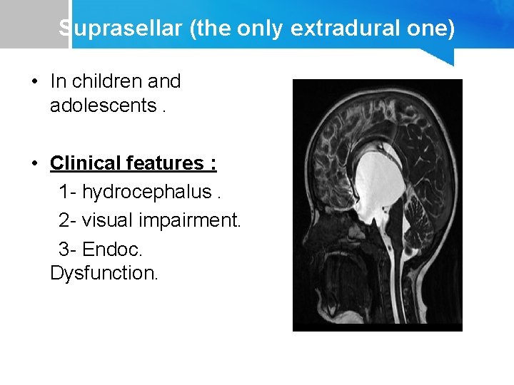 Suprasellar (the only extradural one) • In children and adolescents. • Clinical features :