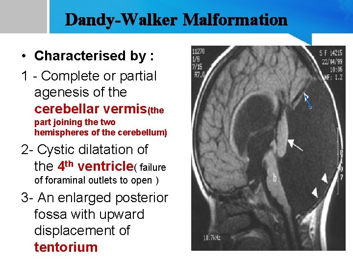 Dandy-Walker Malformation • Characterised by : 1 - Complete or partial agenesis of the
