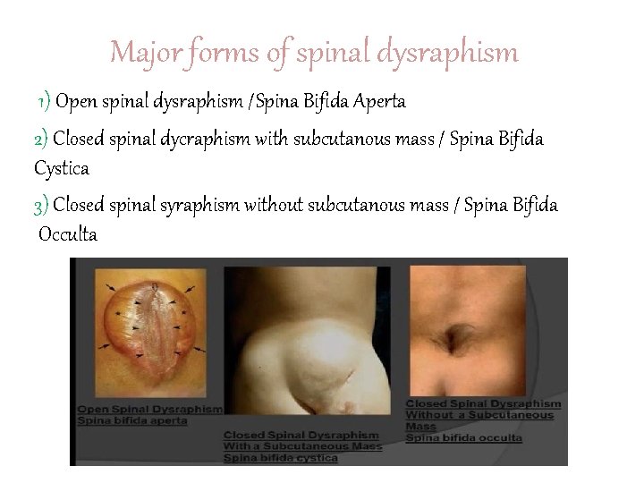 Major forms of spinal dysraphism 1) Open spinal dysraphism /Spina Bifida Aperta 2) Closed