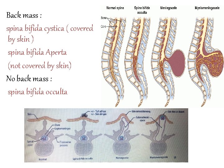Back mass : spina bifida cystica ( covered by skin ) spina bifida Aperta