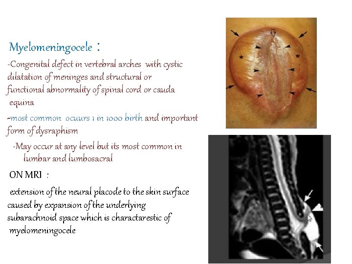 Myelomeningocele : -Congenital defect in vertebral arches with cystic dilatation of meninges and structural