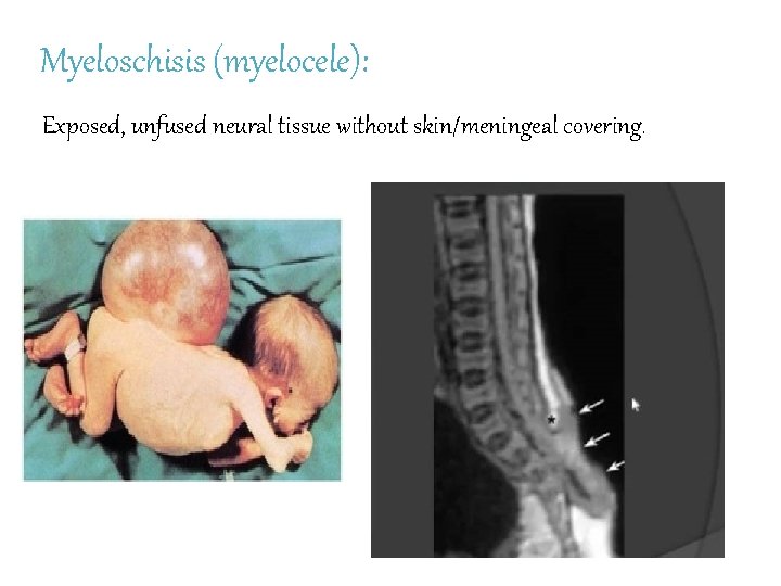 Myeloschisis (myelocele): Exposed, unfused neural tissue without skin/meningeal covering. 