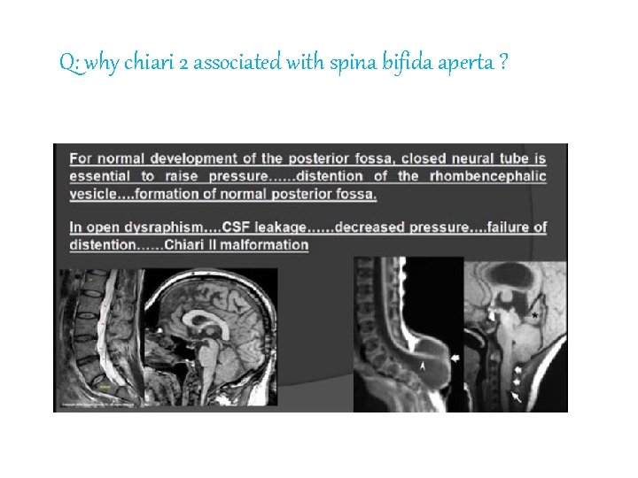 Q: why chiari 2 associated with spina bifida aperta ? 