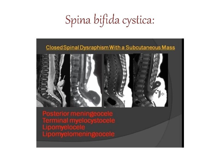 Spina bifida cystica: 