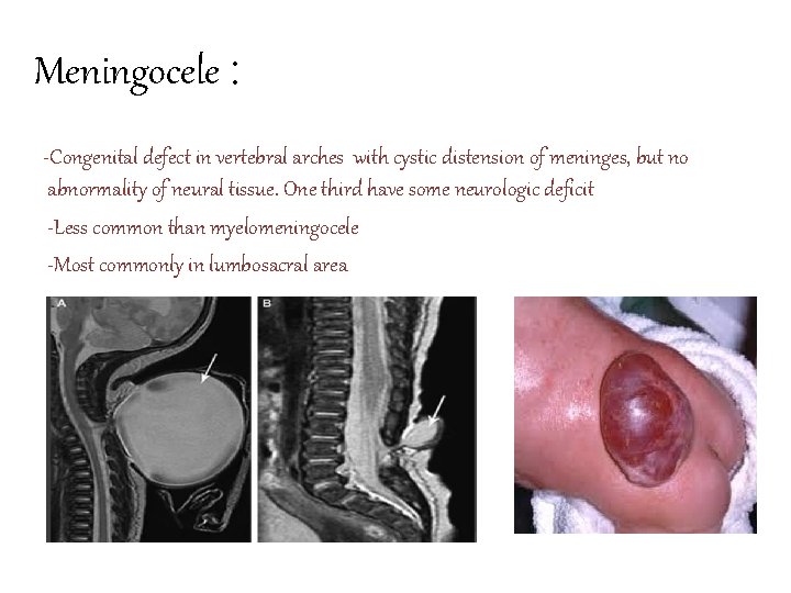 Meningocele : -Congenital defect in vertebral arches with cystic distension of meninges, but no