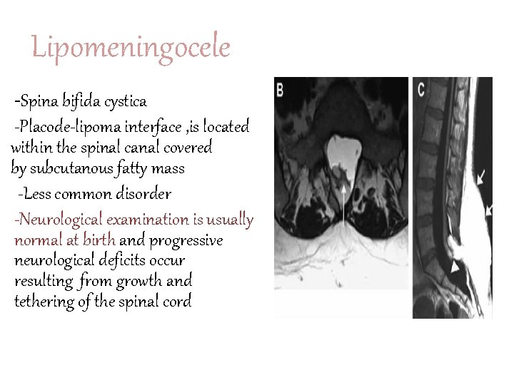 Lipomeningocele -Spina bifida cystica -Placode-lipoma interface , is located within the spinal canal covered