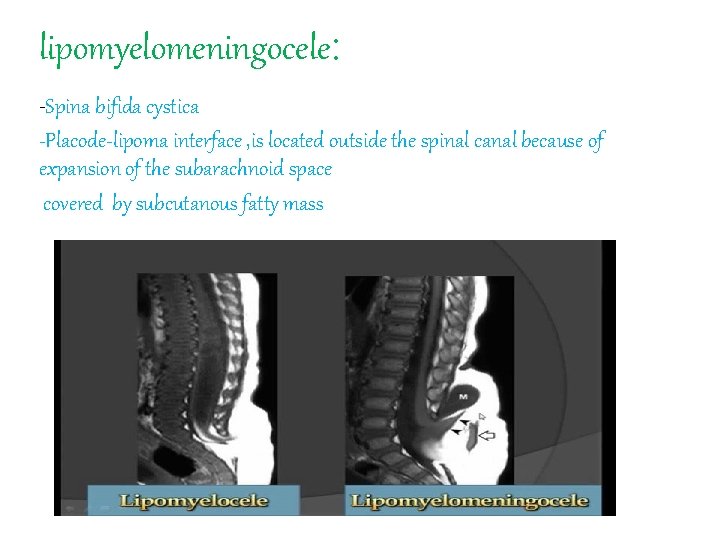 lipomyelomeningocele: -Spina bifida cystica -Placode-lipoma interface , is located outside the spinal canal because