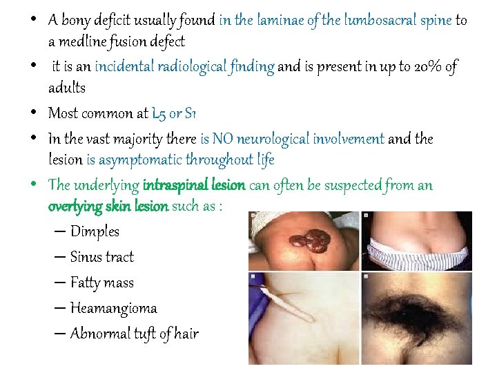  • A bony deficit usually found in the laminae of the lumbosacral spine