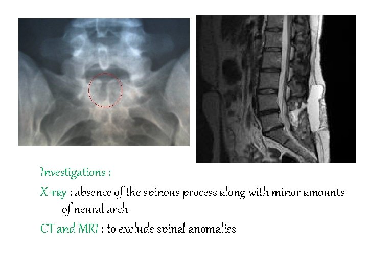 Investigations : X-ray : absence of the spinous process along with minor amounts of