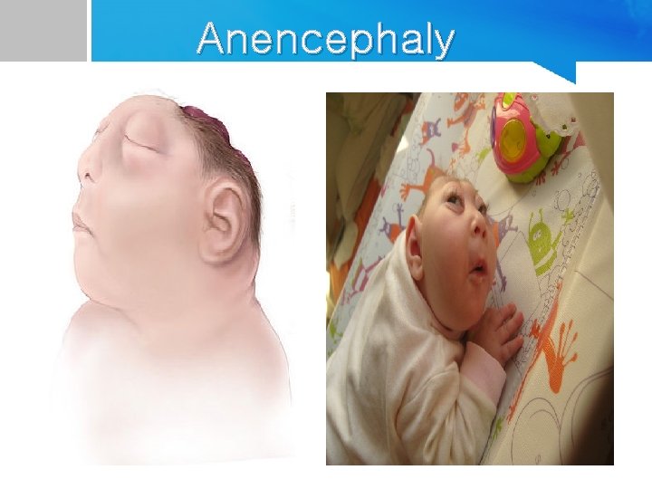 Anencephaly 