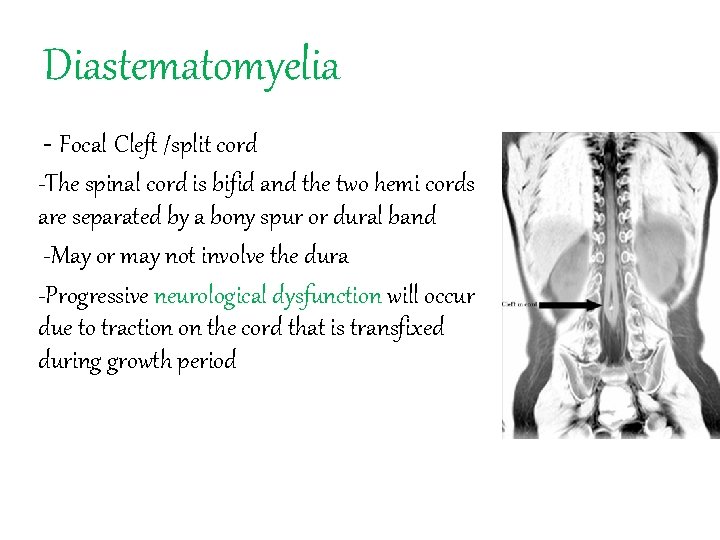 Diastematomyelia - Focal Cleft /split cord -The spinal cord is bifid and the two
