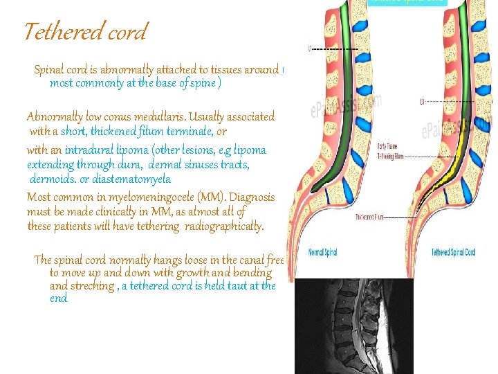 Tethered cord Spinal cord is abnormally attached to tissues around ( most commonly at