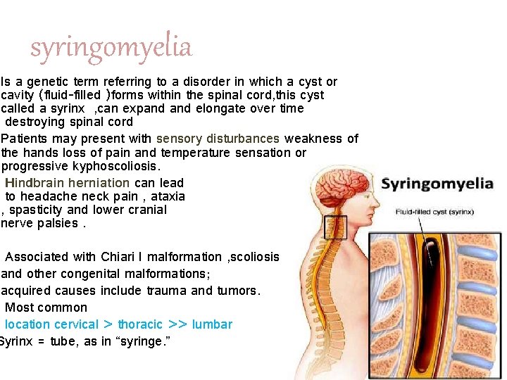 syringomyelia Is a genetic term referring to a disorder in which a cyst or