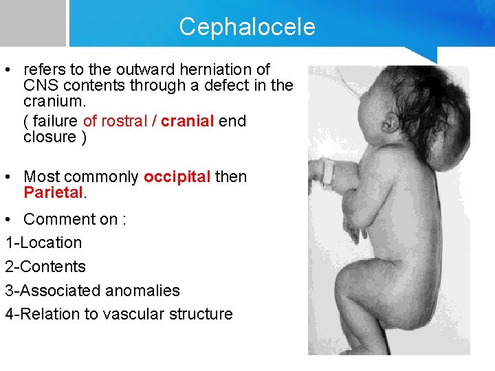 Cephalocele • refers to the outward herniation of CNS contents through a defect in