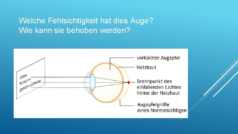 Welche Fehlsichtigkeit hat dies Auge? Wie kann sie behoben werden? 