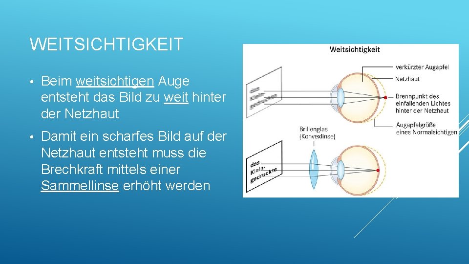 WEITSICHTIGKEIT • Beim weitsichtigen Auge entsteht das Bild zu weit hinter der Netzhaut •