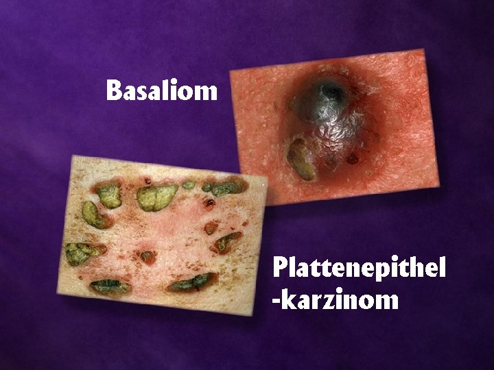 Basaliom Plattenepithel -karzinom 