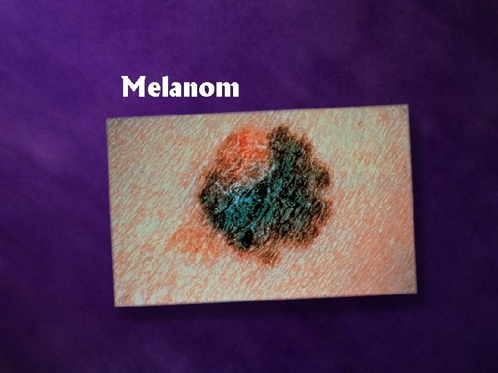 Melanom 