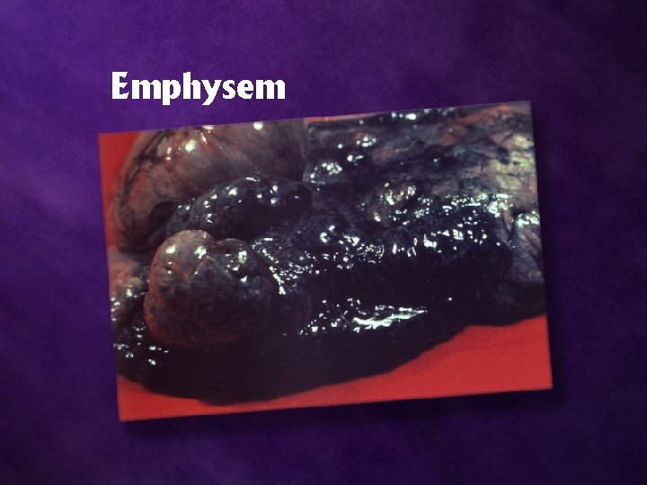 Emphysem 