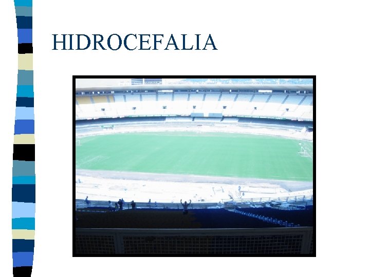 HIDROCEFALIA 