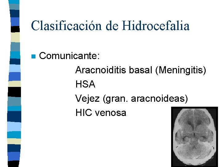 Clasificación de Hidrocefalia n Comunicante: Aracnoiditis basal (Meningitis) HSA Vejez (gran. aracnoideas) HIC venosa