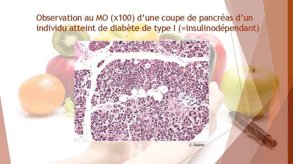 Observation au MO (x 100) d’une coupe de pancréas d’un individu atteint de diabète