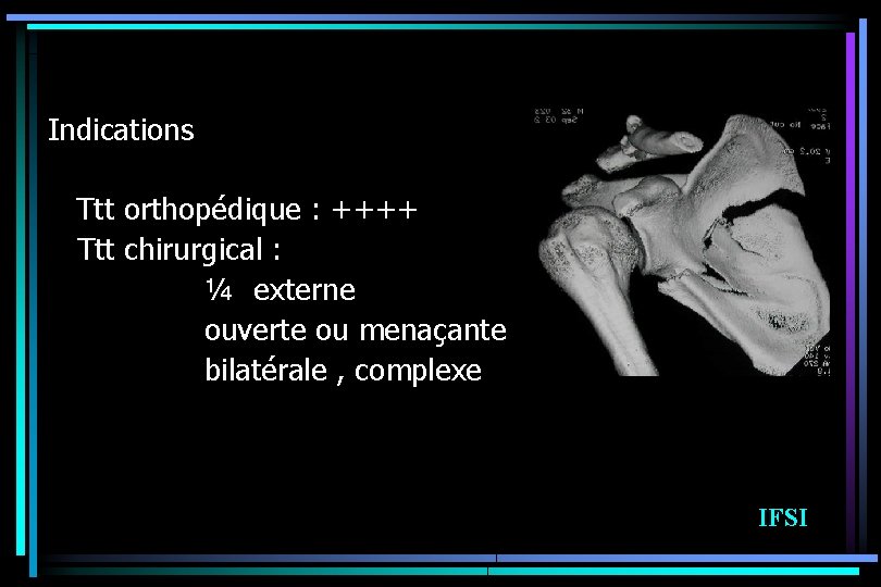 Indications Ttt orthopédique : ++++ Ttt chirurgical : ¼ externe ouverte ou menaçante bilatérale