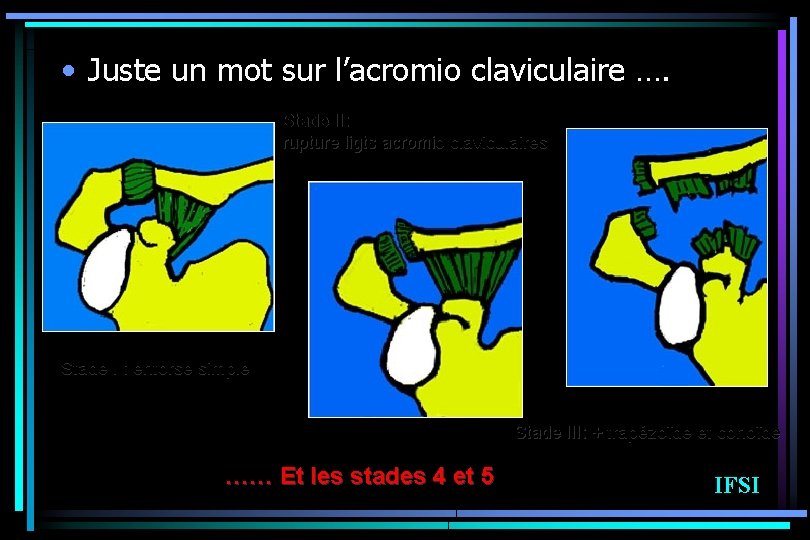  • Juste un mot sur l’acromio claviculaire …. Stade II: rupture ligts acromio