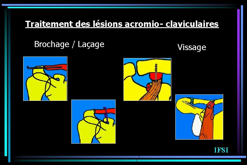 Traitement des lésions acromio- claviculaires Brochage / Laçage Vissage IFSI 