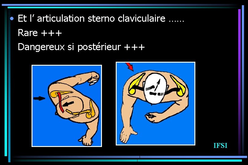  • Et l’ articulation sterno claviculaire …… Rare +++ Dangereux si postérieur +++