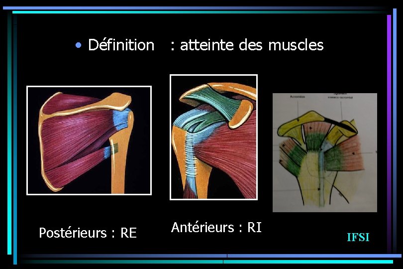  • Définition : atteinte des muscles Postérieurs : RE Antérieurs : RI IFSI