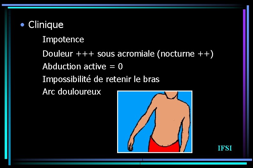  • Clinique Impotence Douleur +++ sous acromiale (nocturne ++) Abduction active = 0