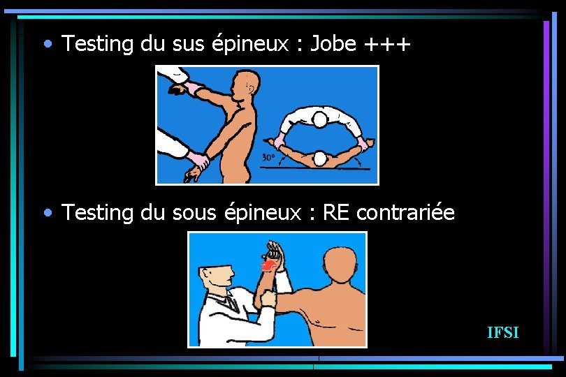  • Testing du sus épineux : Jobe +++ • Testing du sous épineux