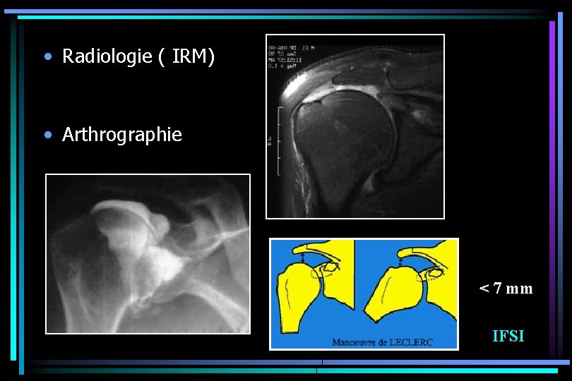  • Radiologie ( IRM) • Arthrographie < 7 mm IFSI 