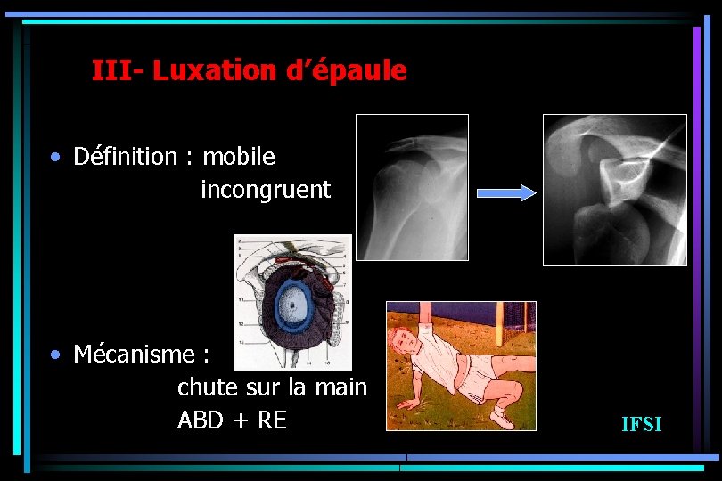 III- Luxation d’épaule • Définition : mobile incongruent • Mécanisme : chute sur la