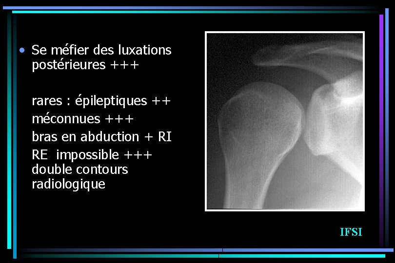  • Se méfier des luxations postérieures +++ rares : épileptiques ++ méconnues +++