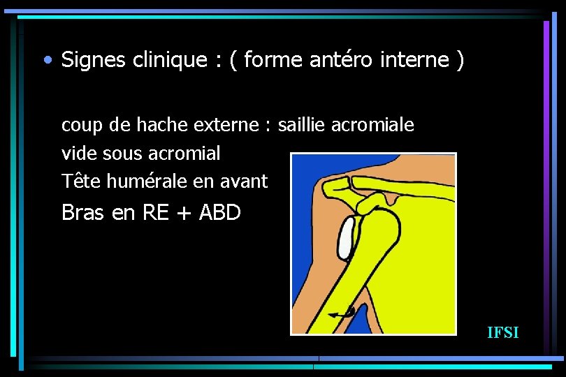  • Signes clinique : ( forme antéro interne ) coup de hache externe