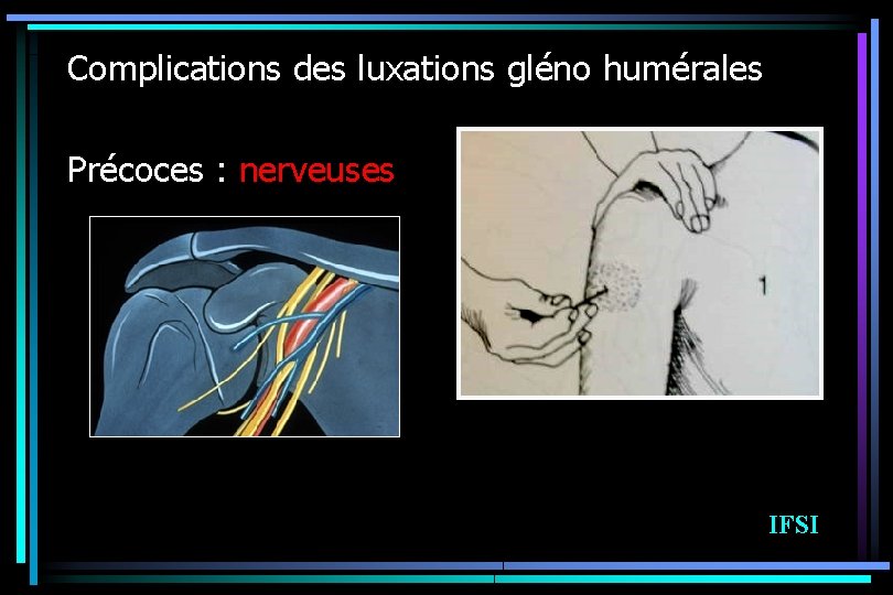 Complications des luxations gléno humérales Précoces : nerveuses IFSI 