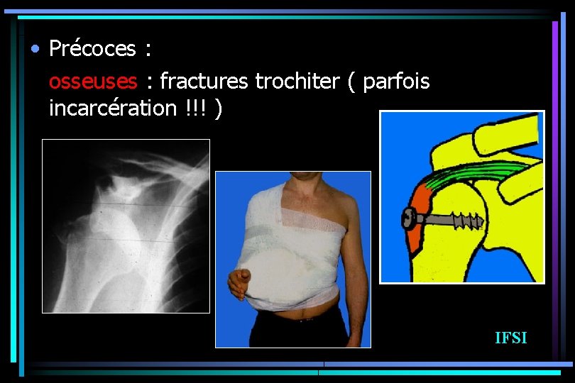  • Précoces : osseuses : fractures trochiter ( parfois incarcération !!! ) IFSI