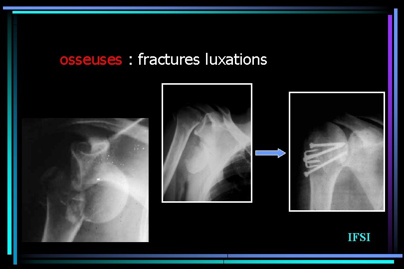 osseuses : fractures luxations IFSI 